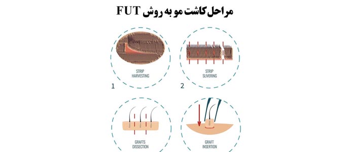 مراحل کاشت مو به روش اف یو تی